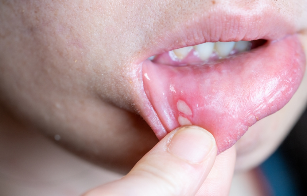 口内炎について