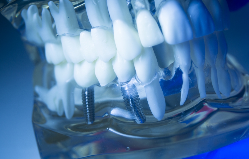 インプラントについて